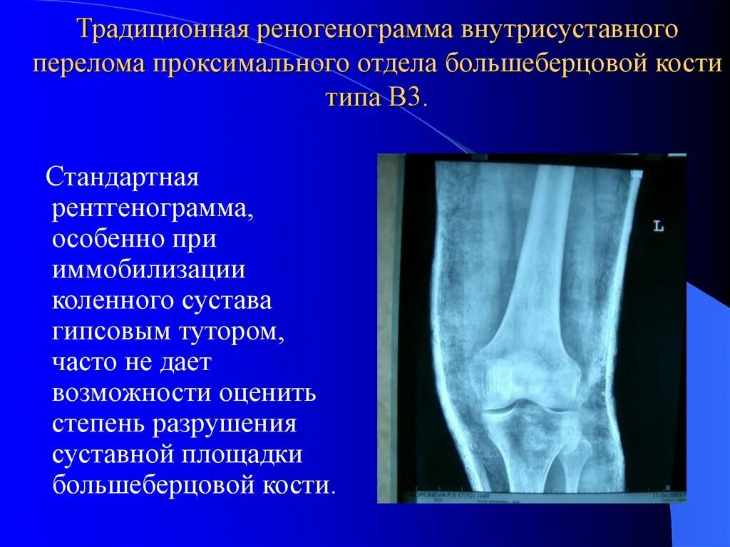 Проксимальный отдел большеберцовой кости фото Перелом суставной кости большеберцовой кости