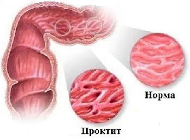 Проктит фото снаружи Проктит: причины, симптомы, лечение поэтапно