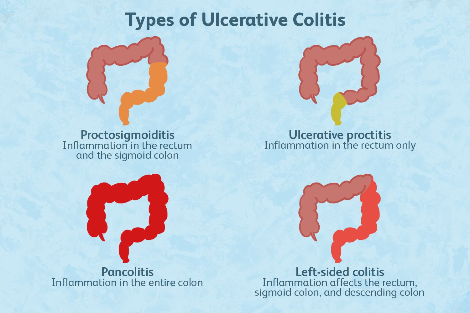 Проктит симптомы фото Types of Ulcerative Colitis (UC), ulcerative colitis - cvu.by