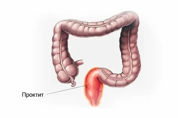 Проктит симптомы фото Проктит ⋮ Лікування проктиту в Medical Plaza