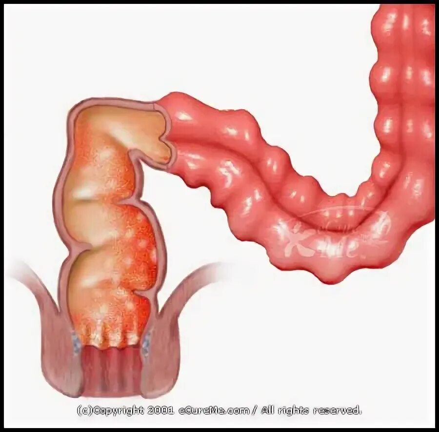 Проктит симптомы фото Chronic Diarrhea: August 2015