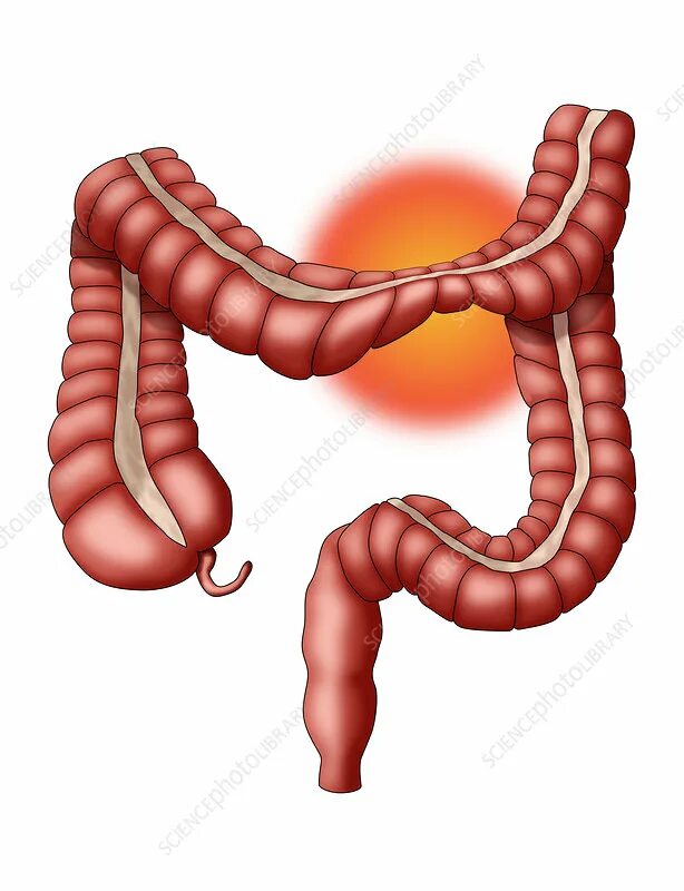 Проктит симптомы фото Irritable Bowel Syndrome (IBS), Illustration - Stock Image - C036/5468 - Science