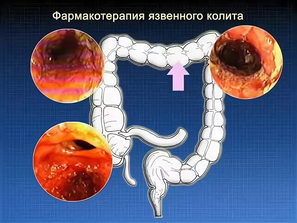 Проктит симптомы фото Фармакотреапия язвенного колита © Pharmacotreapia of ulcerative colitis - YouTub