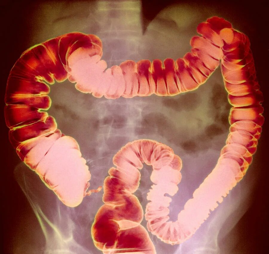 Проктит симптомы фото Large Intestine, X-ray Photograph by Cnri - Fine Art America