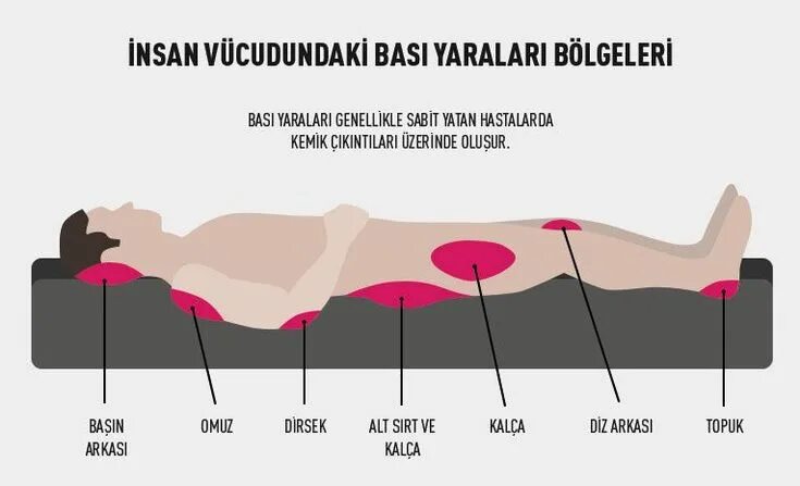 Пролежень 3 стадии фото Yatak yaraları (bası yaraları) Resim, Insan vücudu