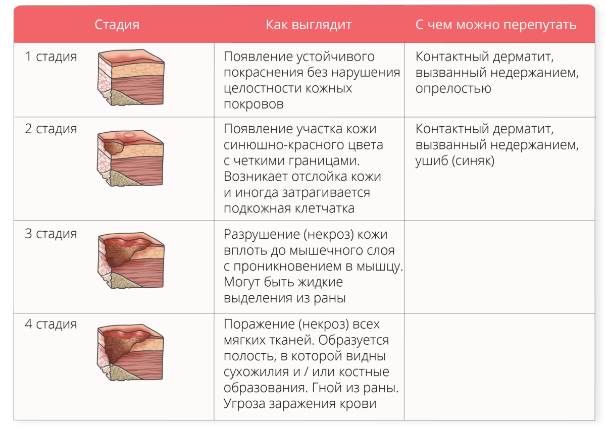 Пролежень 3 стадии фото Схема лечения пролежней 3 степени