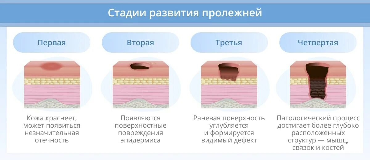 Пролежень 3 стадии фото Профилактика пролежней у лежачих больных: что используют и как проводить?