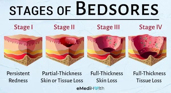 Пролежень 3 стадии фото Bedsores: Stages, How to Heal Them? Is Petroleum Jelly Good? Bed sores, Poor nut