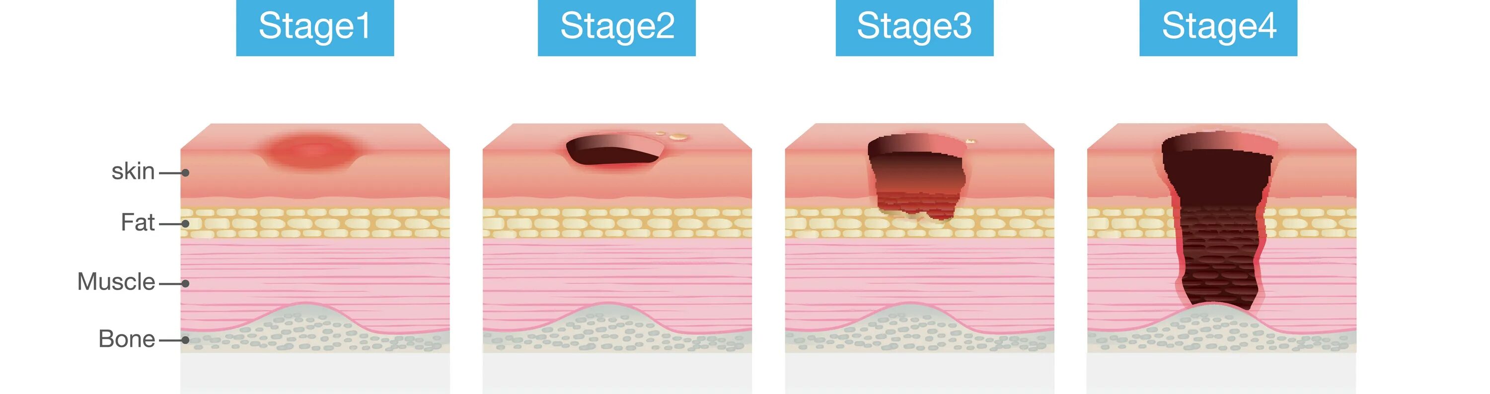 Пролежень 3 стадии фото Pressure Injuries Are Not to be Taken Lightly Shield HealthCare