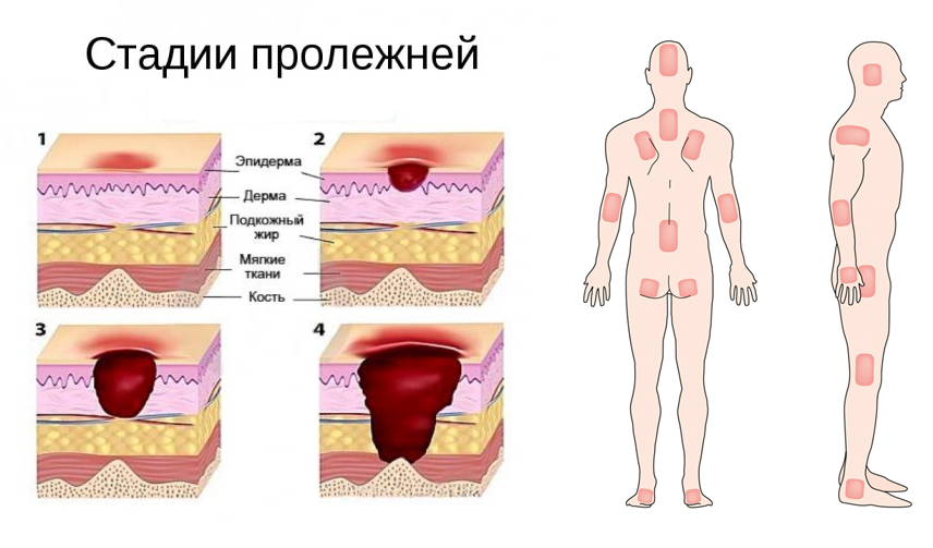 Пролежень 3 стадии фото Памятка для пациентов с пролежнями: Пациентам