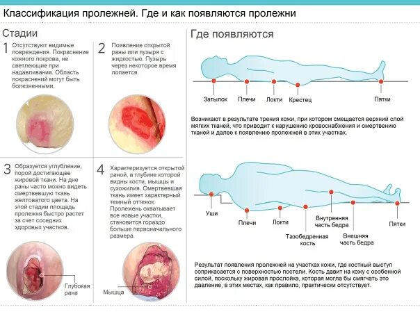 Пролежень 3 стадии фото Пролежни - Фотография 8 из 16 ВКонтакте