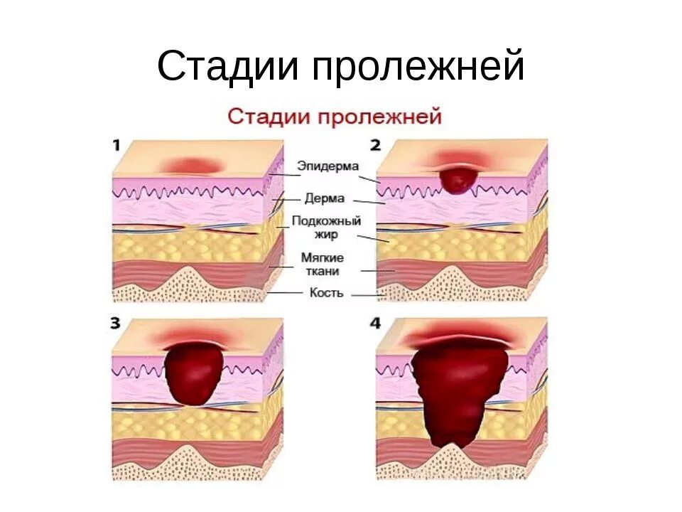 Пролежень 3 стадии фото В статье описаны методы лечения пролежней у лежачих больных, средства профилакти