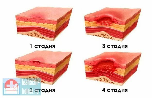 Пролежень 3 стадии фото Особенности лечения пролежней в начальной стадии