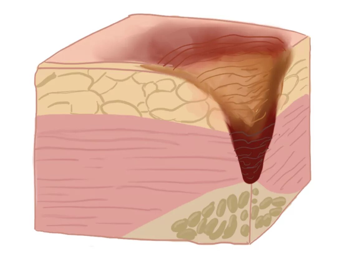 Пролежень 3 стадии фото Пролежни: правила профилактики и лечения - советы врача