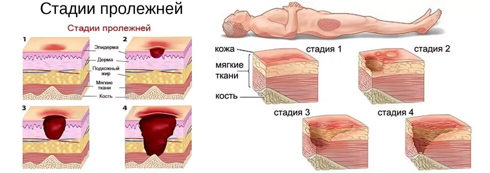 Пролежень 3 стадии фото Глубокие раны 2021