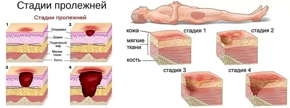 Пролежни 4 стадии фото Спреи и другие средства для лечения пролежней