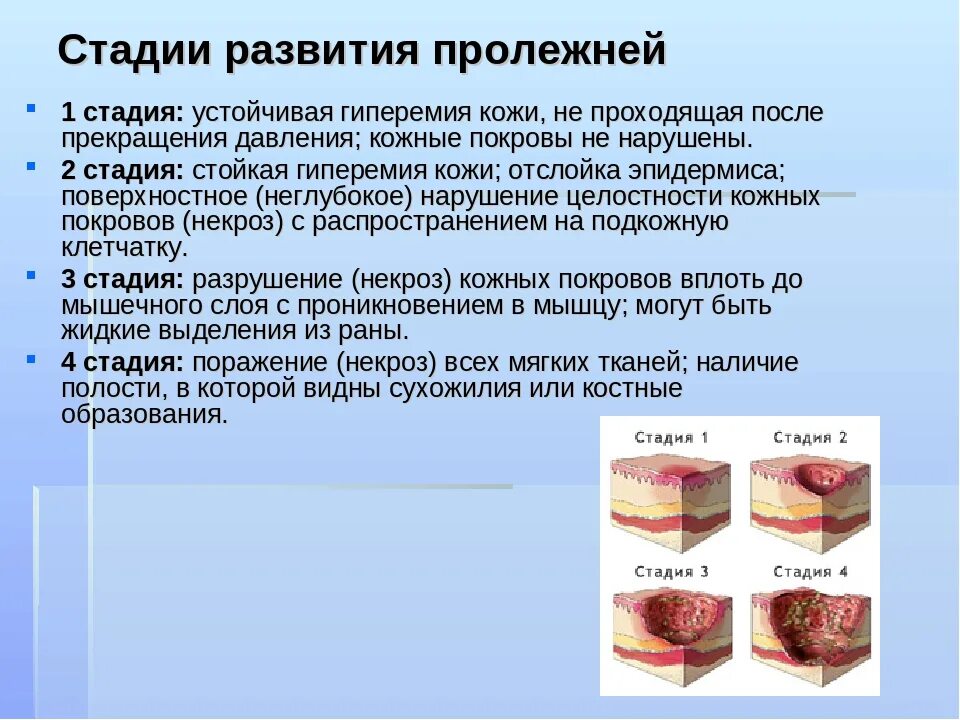 Пролежни 4 стадии фото Чем лечить пролежни у лежачих больных эффективно: найдено 88 изображений