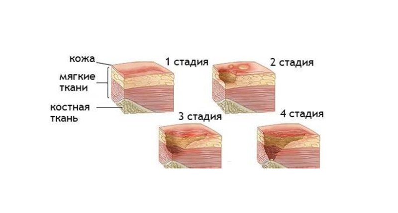 Пролежни 4 стадии фото Трофическая язва - признаки, причины, симптомы, лечение и профилактика - iDoctor