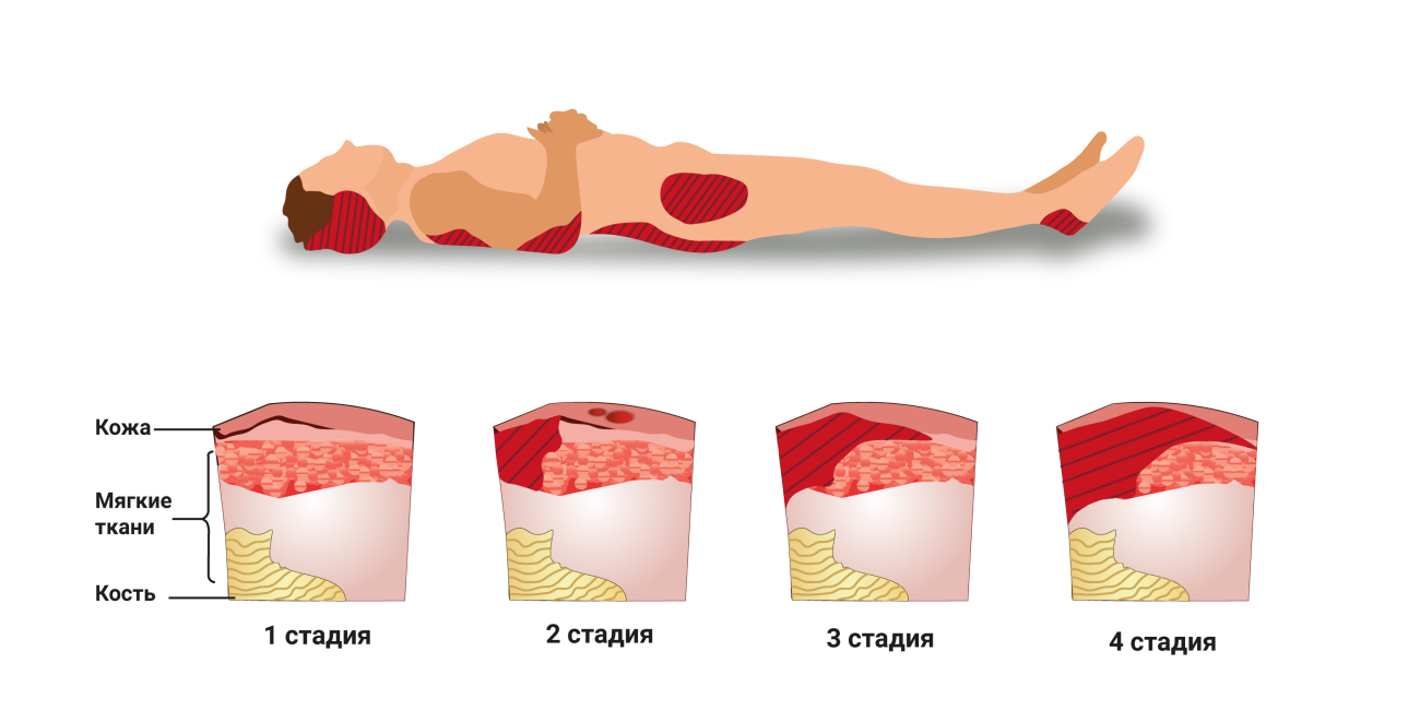 Пролежни 4 стадии фото на человеке Пролежни: стадии, лечение, профилактика у лежачих больных