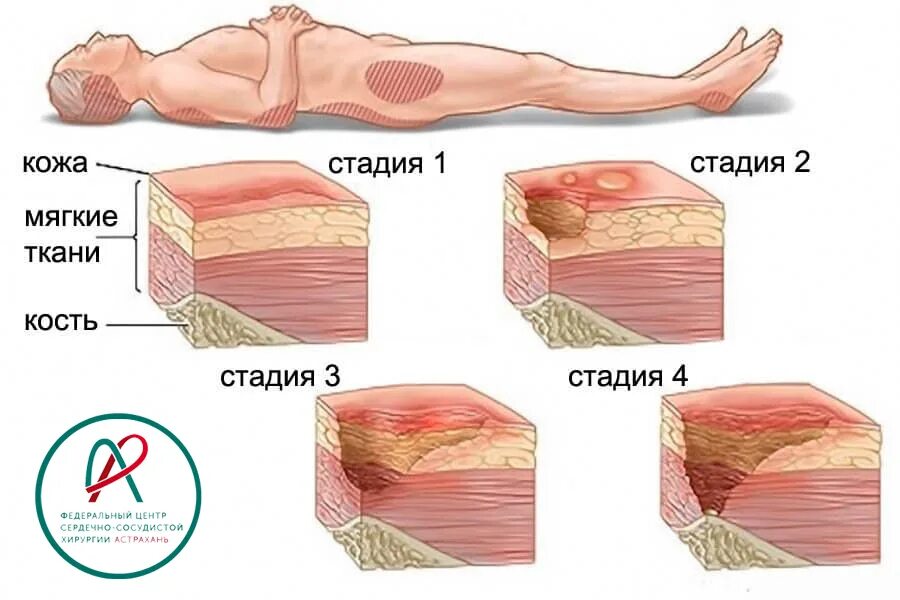 Пролежни 4 стадии фото на человеке Пролежни.