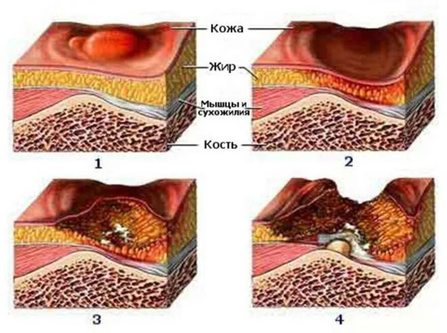 Пролежни 4 стадии фото на человеке Лучшие матрасы для лежачих больных: что нужно знать и как выбрать