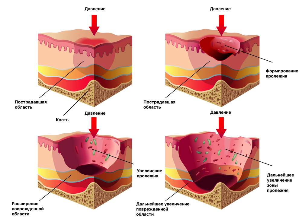 Пролежни четвертой стадии фото Пролежни у лежачих больных - уход и лечение в Москве