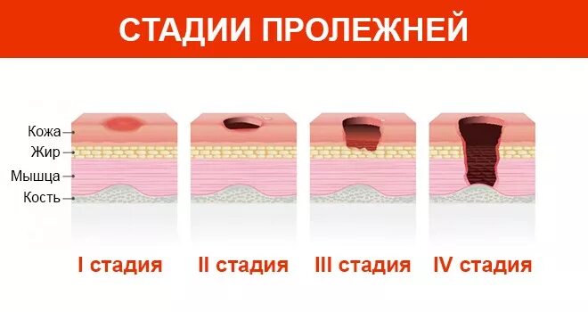 Пролежни четвертой стадии фото Пансионаты для лежачих больных с пролежнями в Саратове и Саратовской области