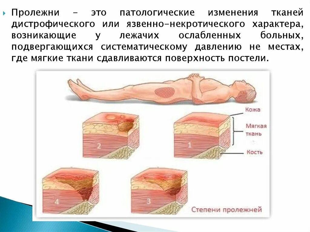 Пролежни до кости фото Положения при пролежнях