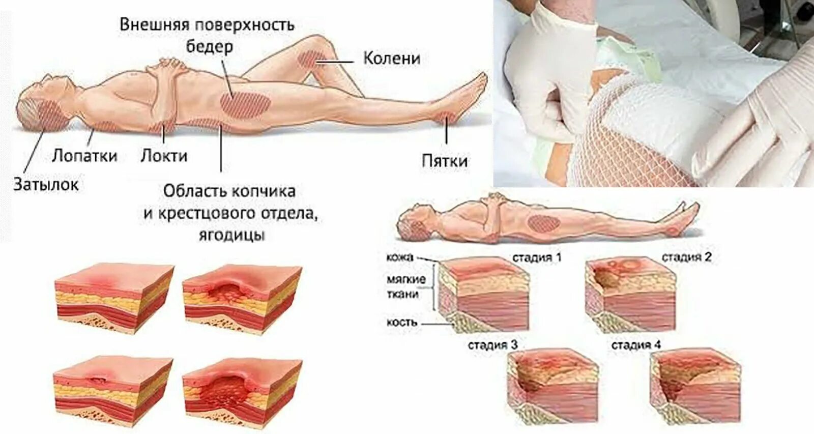 Пролежни до кости фото на человеке Пролежень степени лечение - найдено 80 фото