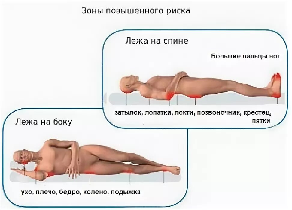 Пролежни фото как выглядят у человека лежачего Противопролежневые матрасы с компрессором противопоказания