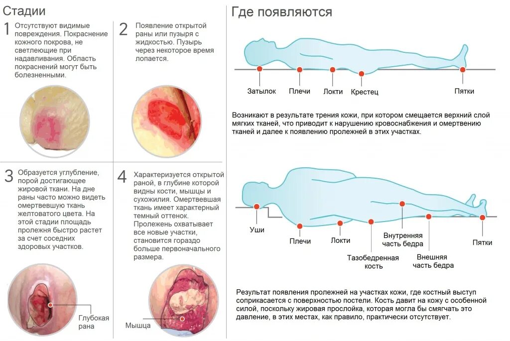 Пролежни фото как выглядят у человека лежачего Чем лечить пролежни у пожилого лежачего человека и как правильно проводить профи