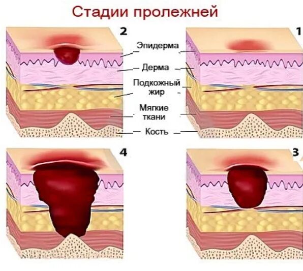 Пролежни фото как выглядят у человека лежачего Занятие № 3 - БУ "Центральная городская больница" Минздрава Чувашии