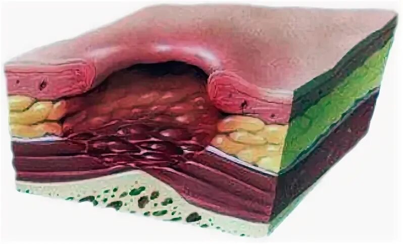 Пролежни фото по стадиям Степени развития пролежней: Стадии пролежней