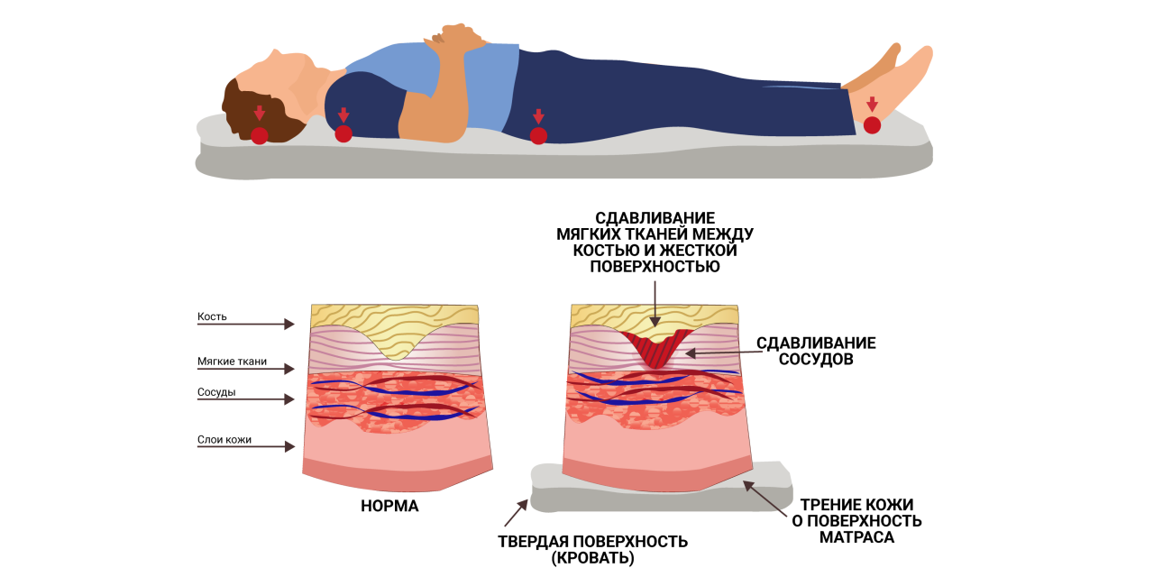 Пролежни фото по стадиям на человеке Мази и кремы для обработки и лечения пролежней у лежачих больных