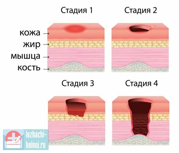 Пролежни как выглядят на начальной стадии фото Стадии пролежней рисунки