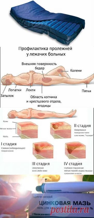 Пролежни на попе фото Пролежни на ягодицах: лечение в домашних условиях, фото, видео Рецепты народной 