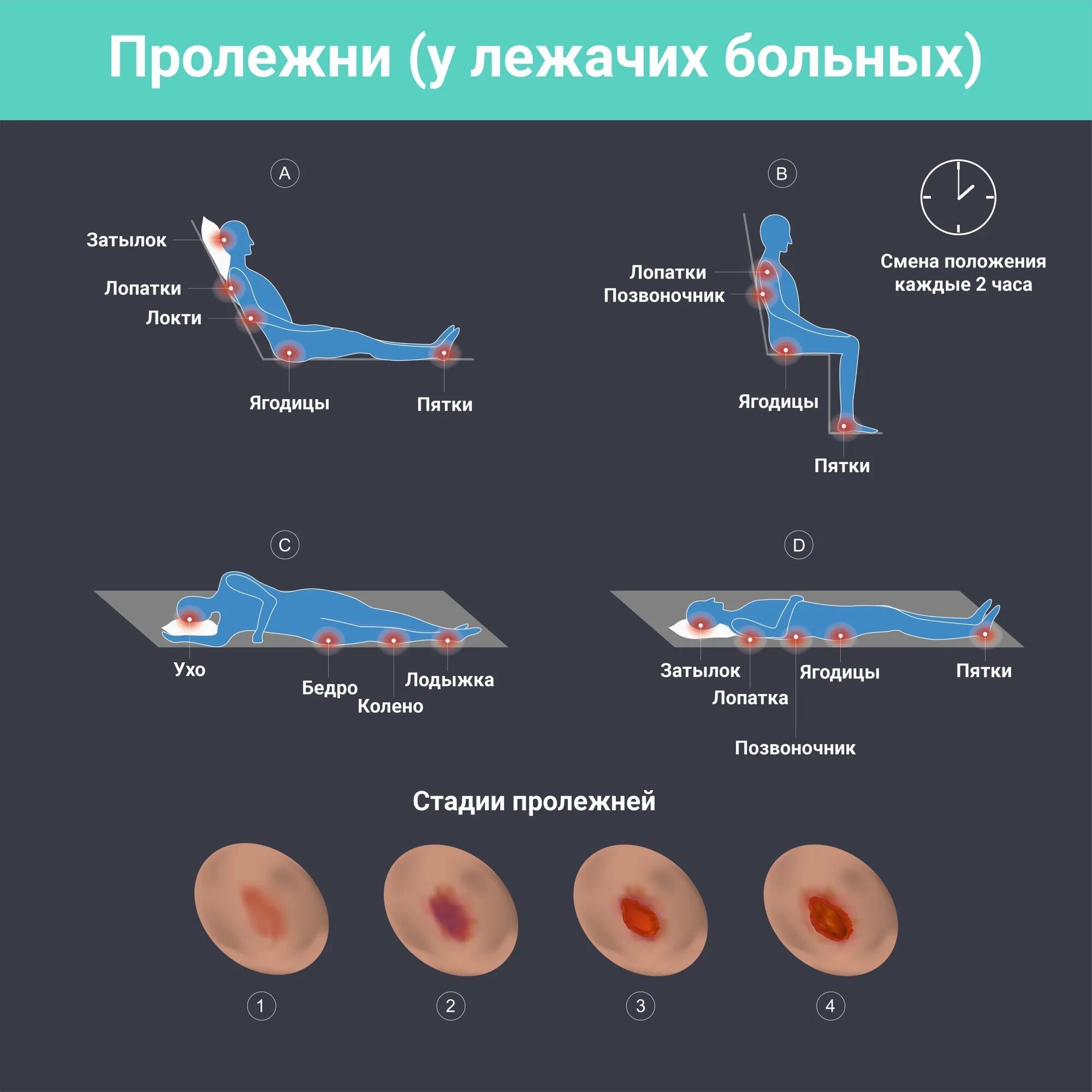 Пролежни на попе фото Отит - лечение у взрослых дома, советы при наружном отите