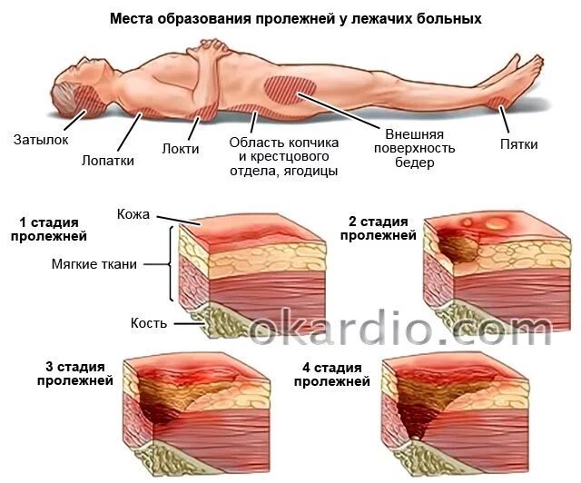 Пролежни последней стадии фото Буклет Почему появляются пролежни - пролежни - Стадии пролежней i стадия