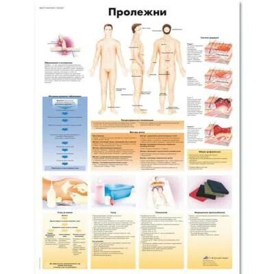 Пролежни разных стадий фото Медицинские плакаты 3b-sayntifik