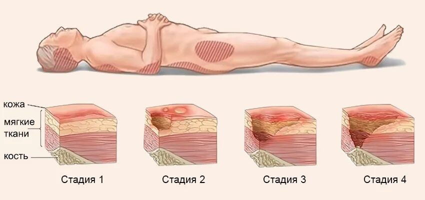 Пролежни у лежачих стадии фото Пролежни