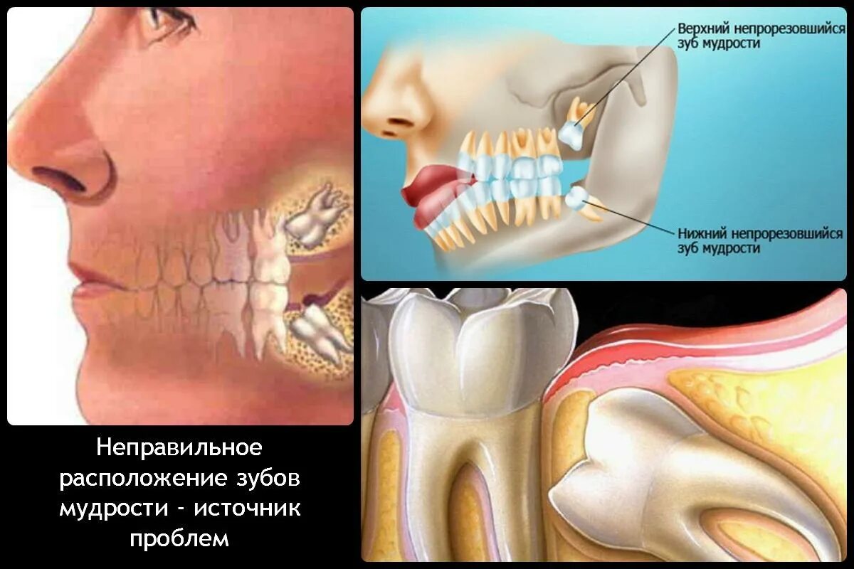 Прорезывание зуба мудрости фото Удаление зуба мудрости, цены на удаление зубов мудрости в СПб - Анле-Дент