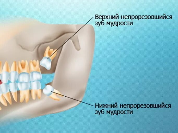 Прорезывание зуба мудрости фото Зуб мудрости на картинке