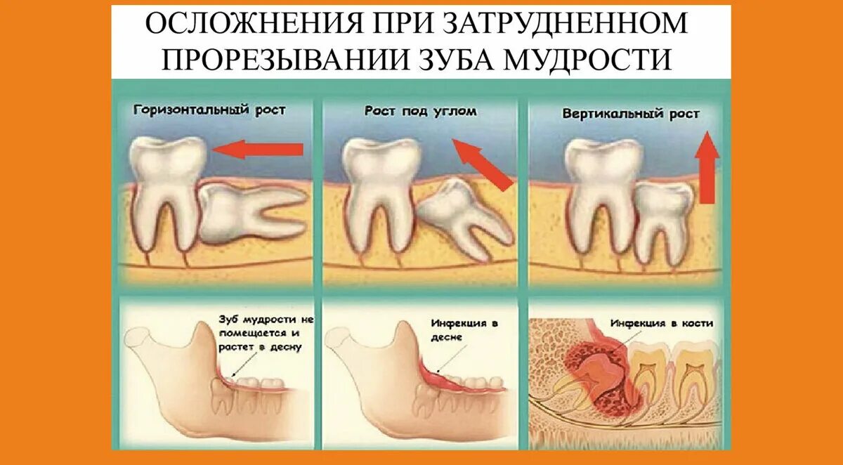 Прорезывание зуба мудрости фото Почему болит зуб? 7 возможных причин. ZiZi Dent Авторская стоматология Дзен