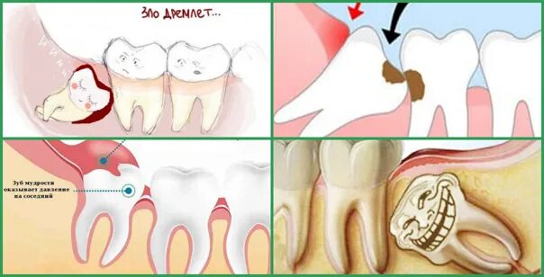 Прорезывание зуба мудрости фото Зуб отдает в другой зуб: найдено 90 изображений