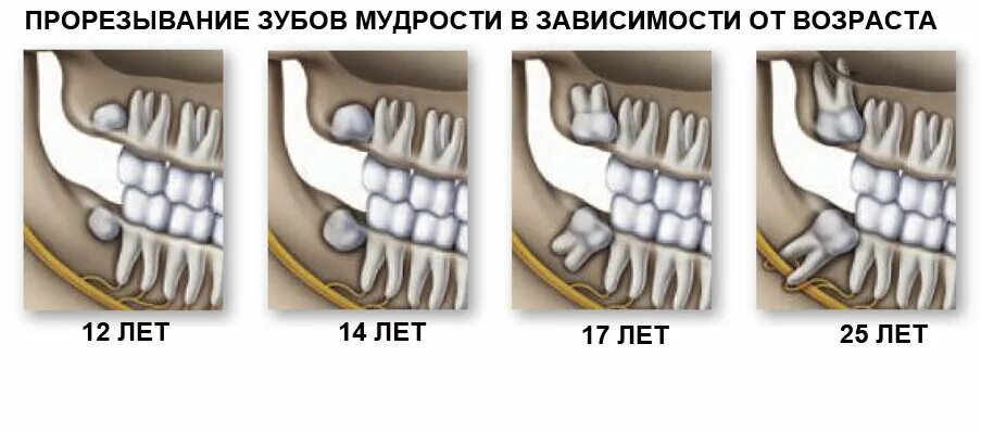 Прорезывание зуба мудрости фото Безболезненное удаление зуба мудрости на аппарате "пьезотом" в Симферополе Лечен