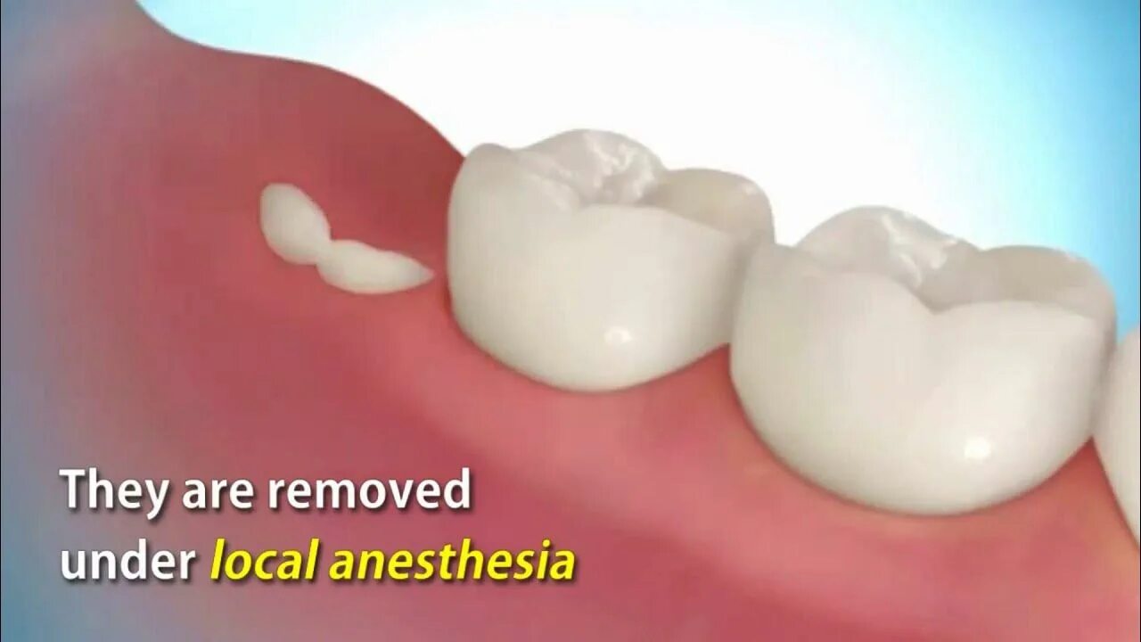 Прорезывание зуба мудрости фото How wisdom tooth is removed. (Yirmilik dişleri nasıl kaldırılır) - YouTube