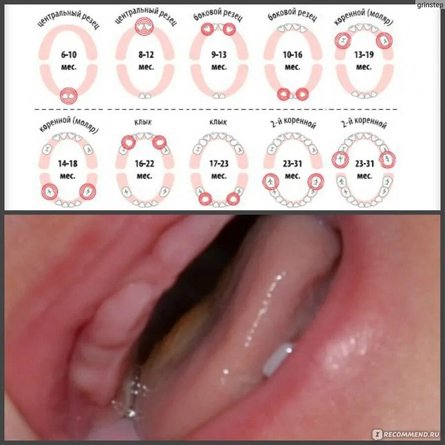 Прорезывание зубов фото десны нижних зубов Сколько дней лезет первый зуб у грудничка: длительность роста и прорезывания