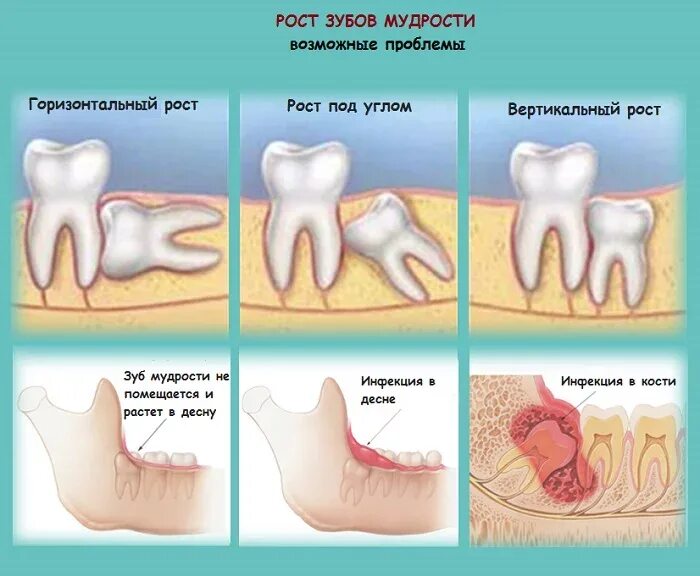 Прорезывание зубов мудрости фото десны Лечение зуба мудрости в Москве Клиника Медлайн сервис