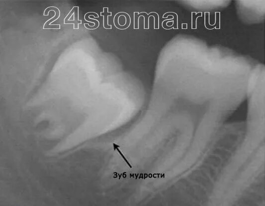 Прорезывание зубов мудрости фото десны Зуб мудрости растет и болит десна - что делать, быстрая помощь