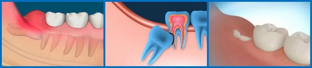 Прорезывание зубов мудрости фото десны Для чего нужны зубы мудрости, какая польза от зубов мудрости?
